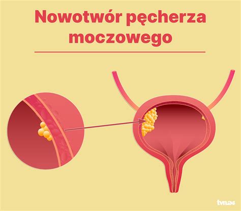 Schemat diagnostyki raka pęcherza moczowego