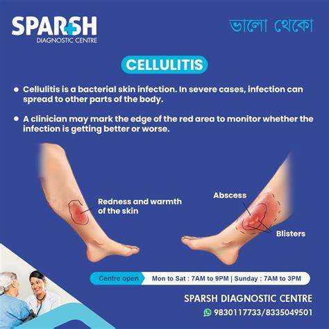 Porównanie wizualne cellulitu i cellulitis.